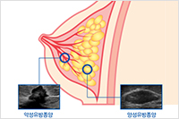 유방종물