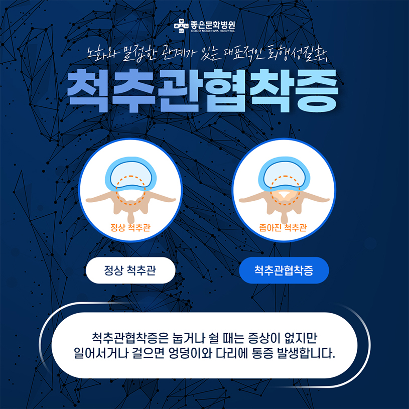 척추관 협착증1