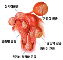 장막하근종, 유경성근종, 근충내근종, 광간막근종, 점막하근종, 유경성 점막하근종