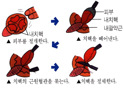 내치핵:피부를 절개한다, 피부 내치핵 내괄약근:치핵을 떼어낸다, 치핵의 근원혈관을 묶는다, 치핵을 절제한다