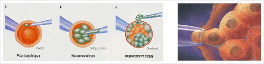 착상전 유전진단 (Preimplantation Genetic Diagnosis) 