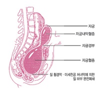 자궁, 자궁내막혈증, 자궁경부, 자궁혈증, 질 횡경막 미세천공 처녀막에 의한 질하부 완전폐쇄