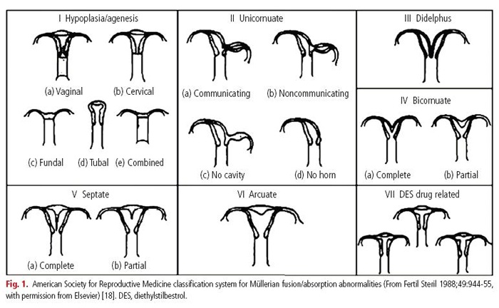 Fig.1. American Society for Reproductive Medicine classification system for Mullerian fusion/absorption abnormalities(From Fertil Steril 1988;49:944-55, with permission from Elsevier)[18].DES, diethylstilbestrol.