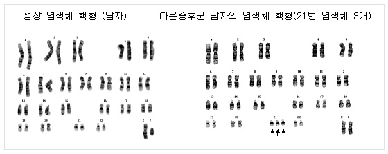 정상 염색체 핵형(남자), 다운증후군 남자의 염색체 핵형(21번 염색체 3개)